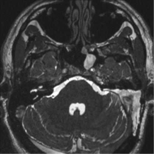Acoustic schwannoma (translabyrinthine resection) (Radiopaedia 43570-46972 Axial CISS 31).png