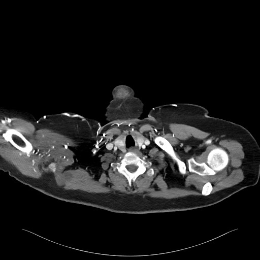 Acromioclavicular joint cyst (Radiopaedia 58455-65610 Axial C+ arterial phase 15).jpg