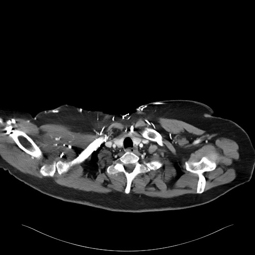 Acromioclavicular joint cyst (Radiopaedia 58455-65610 Axial C+ arterial phase 18).jpg