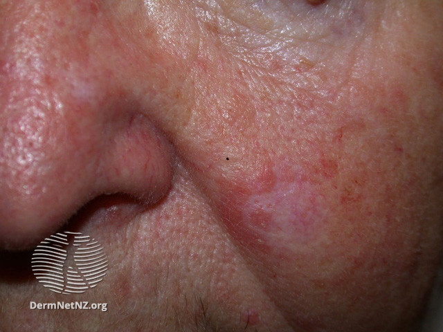 Actinic Keratoses affecting the face (DermNet NZ lesions-ak-face-375).jpg