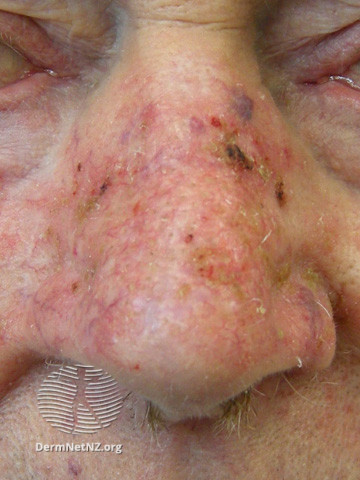 File:Actinic keratoses on the nose (DermNet NZ lesions-sks-nose2).jpg