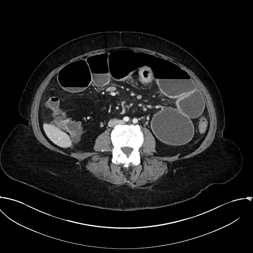 Active Crohn disease (Radiopaedia 59394-66750 Axial C+ portal venous phase 41).jpg
