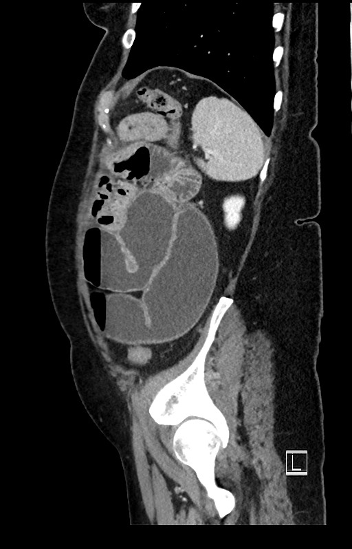 Active Crohn disease (Radiopaedia 59394-66750 Sagittal C+ portal venous phase 12).jpg