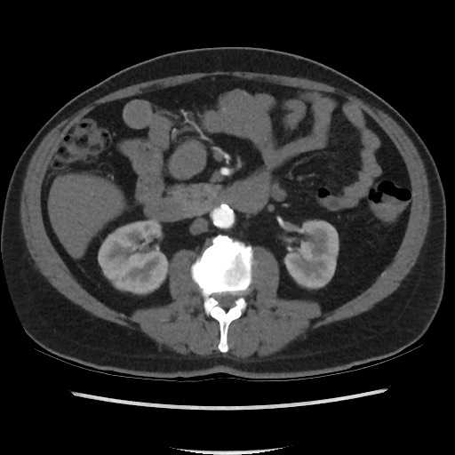 File:Active colonic bleed on CT (Radiopaedia 49765-55025 Axial C+ arterial phase 37).jpg