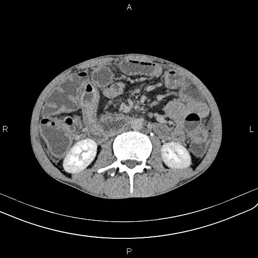 Active crohn disease (Radiopaedia 87133-103397 Axial C+ delayed 27).jpg