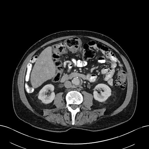 File:Active lower gastrointestinal bleeding - diverticular (Radiopaedia 61203-69106 Axial C+ portal venous phase 63).jpg