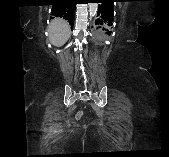 File:Active renal extravasation with large subcapsular and retroperitoneal hemorrhage (Radiopaedia 60975-68796 Coronal C+ portal venous phase 124).jpg