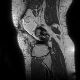 Acute-on-chronic transient lateral patellar dislocation with trochlear dysplasia (Radiopaedia 84099-99349 Sagittal PD 132).jpg