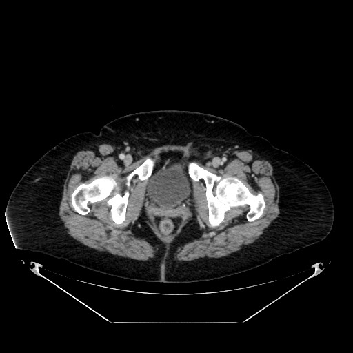 Acute appendicitis, heterotaxy syndrome (Radiopaedia 66884-76202 Axial C+ portal venous phase 127).jpg