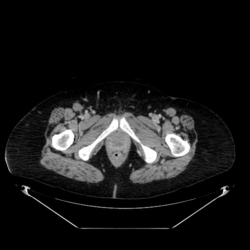 Acute appendicitis, heterotaxy syndrome (Radiopaedia 66884-76202 Axial C+ portal venous phase 135).jpg