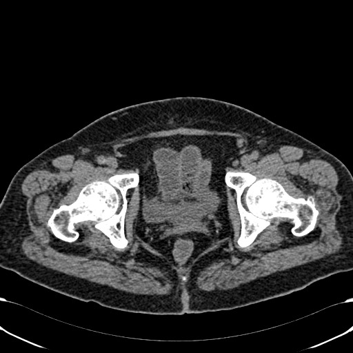Acute appendicitis (Radiopaedia 58627-65818 Axial non-contrast 84).jpg
