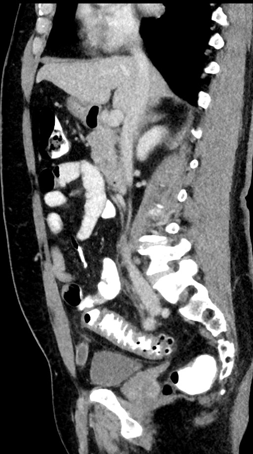 Acute appendicitis (Radiopaedia 77016-88960 Sagittal C+ portal venous phase 67).jpg
