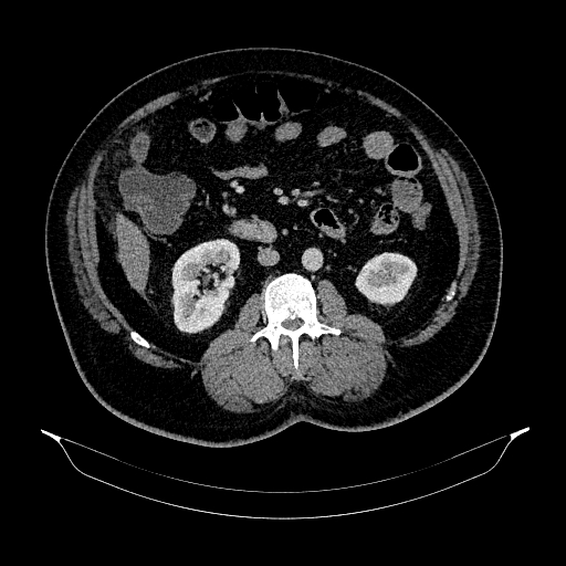 Acute appendicitis (Radiopaedia 79950-93224 Axial C+ portal venous phase 50).jpg
