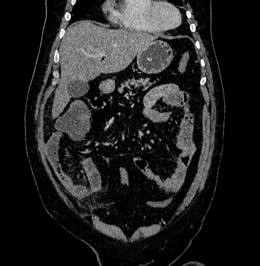 File:Acute appendicitis (Radiopaedia 79950-93224 Coronal C+ portal venous phase 26).jpg