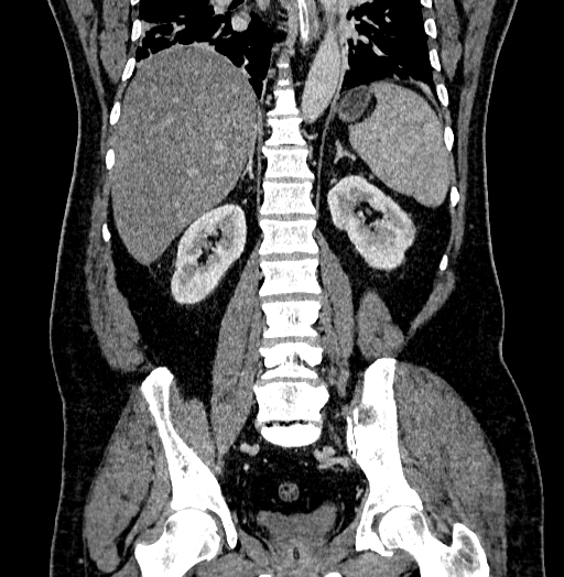 File:Acute appendicitis (Radiopaedia 79950-93224 Coronal C+ portal venous phase 63).jpg
