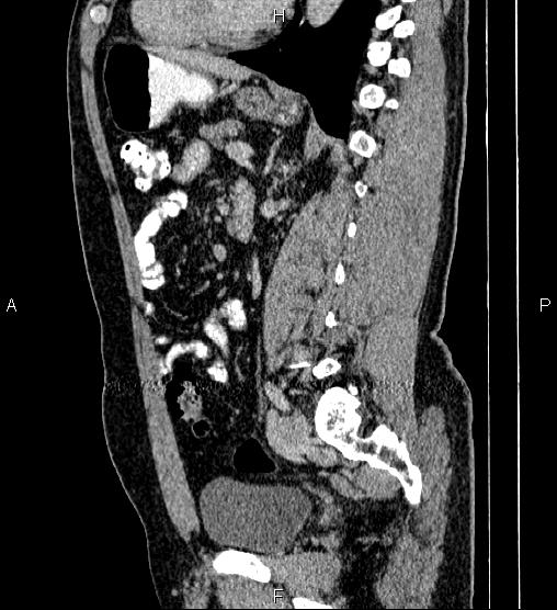 Acute appendicitis (Radiopaedia 84780-100240 Sagittal C+ portal venous phase 63).jpg