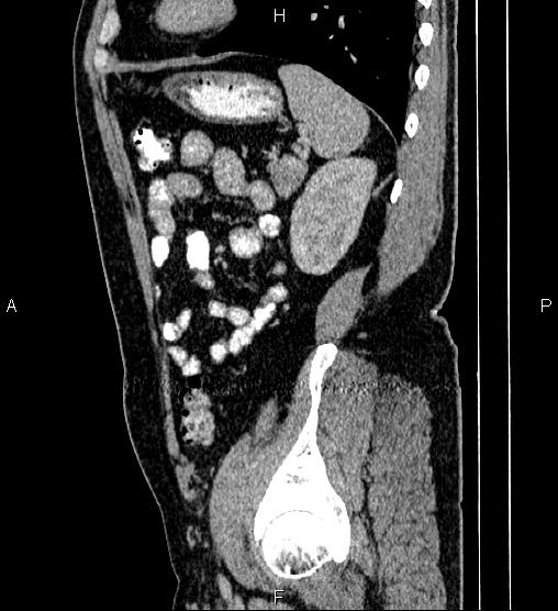 File:Acute appendicitis (Radiopaedia 84780-100240 Sagittal C+ portal venous phase 81).jpg