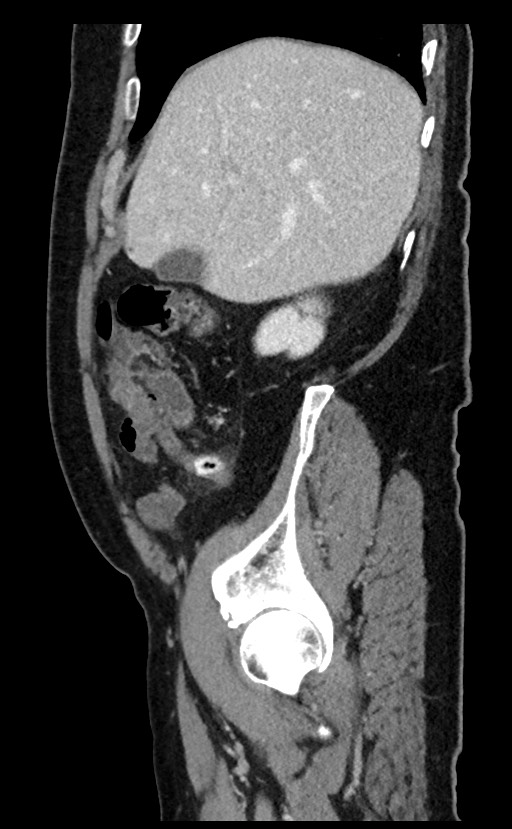 Acute appendicitis - large appendicoliths (Radiopaedia 61805-69820 Sagittal C+ portal venous phase 90).jpg