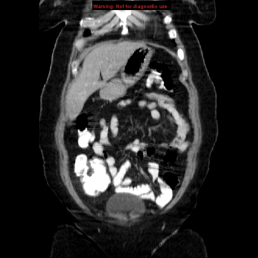 Acute appendicitis complicated by ovarian vein thrombophlebitis (Radiopaedia 16172-15851 Coronal C+ portal venous phase 22).jpg