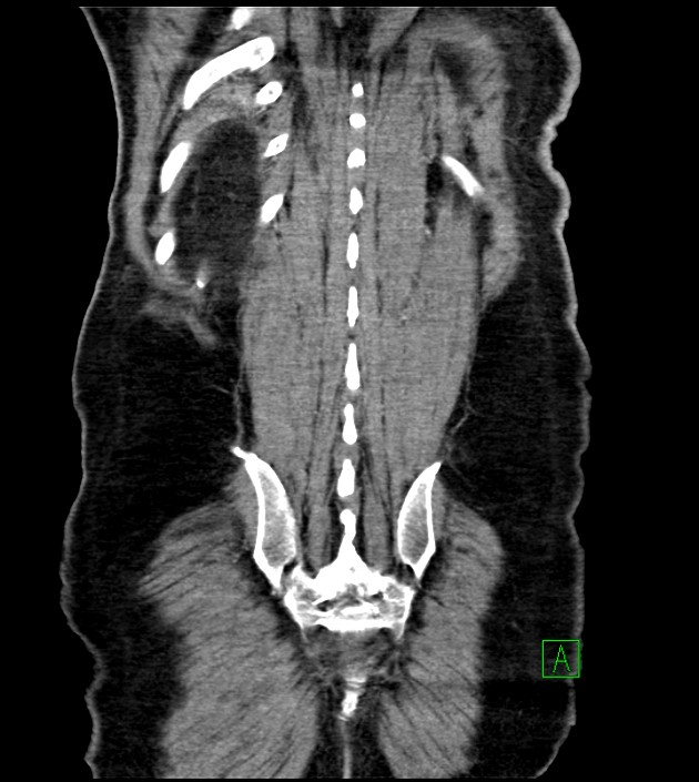 Acute arterial mesenteric ischemia (Radiopaedia 78238-90828 Coronal C+ portal venous phase 79).jpg