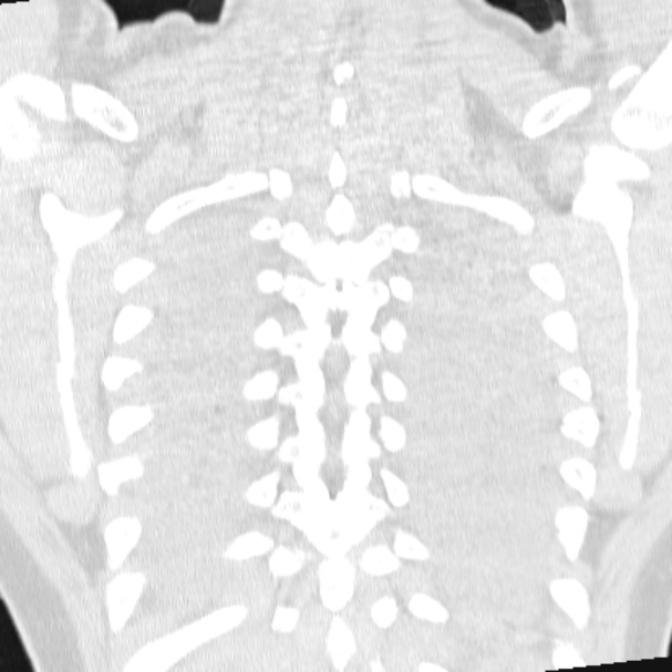 Acute aspiration pneumonitis (Radiopaedia 33605-34703 Coronal lung window 68).jpg