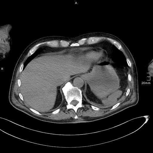 Acute aspiration pneumonitis (Radiopaedia 55642-62166 Axial liver window 54).jpg