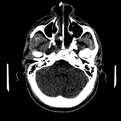 Acute basilar artery occlusion (Radiopaedia 43582-46985 Axial non-contrast 50).jpg