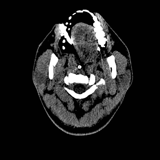 Acute basilar artery occlusion (Radiopaedia 43582-46985 Axial non-contrast 9).jpg