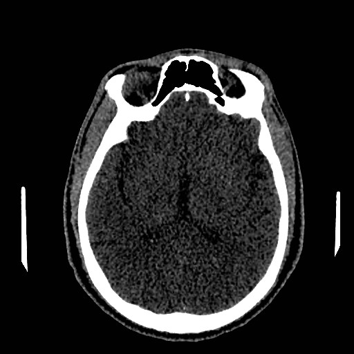 Acute basilar artery occlusion (Radiopaedia 43582-46985 Axial non-contrast 96).jpg