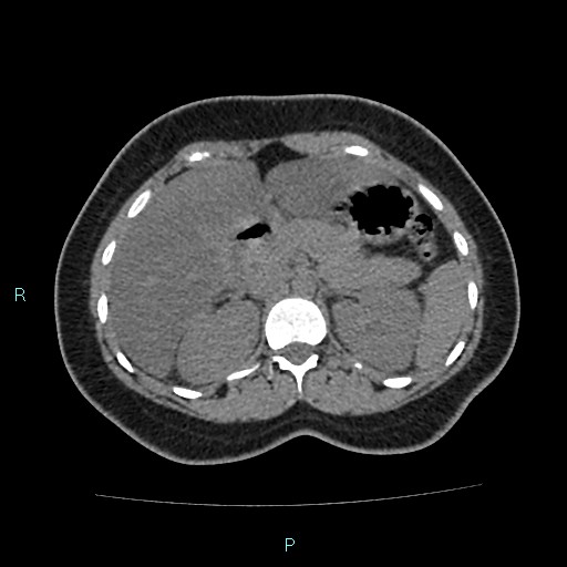 Acute bilateral pyelonephritis (Radiopaedia 37146-38881 Axial non-contrast 34).jpg