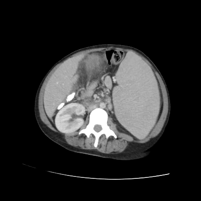 Acute calculous cholecystitis in patient with osteopetrosis (Radiopaedia 77871-90159 Axial C+ portal venous phase 45).jpg