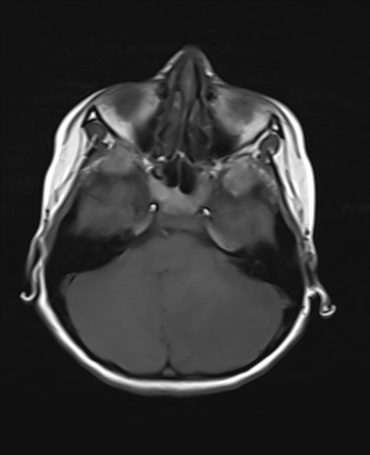 File:Acute cerebellar ataxia (Radiopaedia 61487-69446 Axial T1 5).jpg