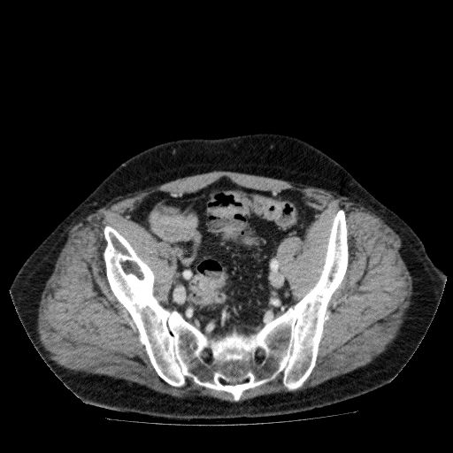 File:Acute cholecystitis and incidental left sided IVC (Radiopaedia 49352-54459 Axial C+ portal venous phase 125).jpg