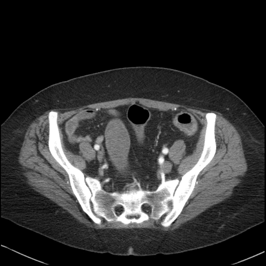 Acute colonic hemorrhage in ulcerative colitis (Radiopaedia 77415-89538 Axial C+ arterial phase 104).jpg