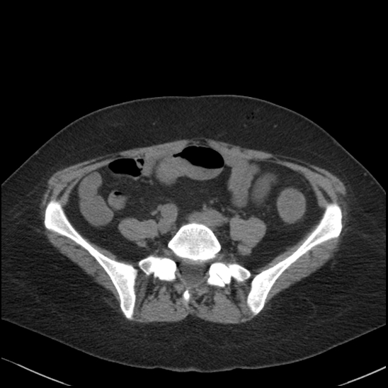 Acute colonic hemorrhage in ulcerative colitis (Radiopaedia 77415-89538 Axial non-contrast 93).jpg
