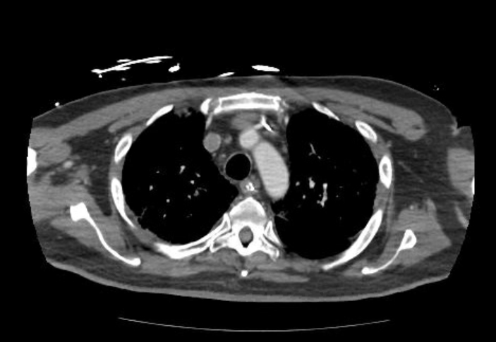 Acute cor pulmonale (ultrasound) (Radiopaedia 83508-98818 Axial C+ CTPA 16).jpg