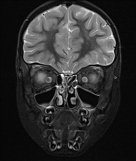 File:Acute disseminating encephalomyelitis with bilateral optic neuritis (Radiopaedia 79676-92886 Coronal STIR 7).jpg