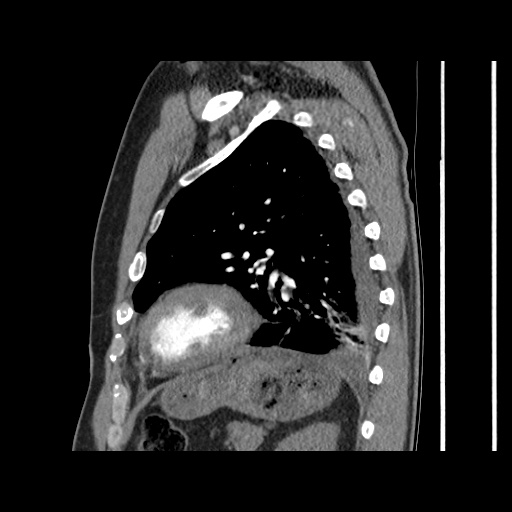 Acute epicardial fat necrosis (Radiopaedia 42327-45440 Sagittal C+ CTPA 51).jpg
