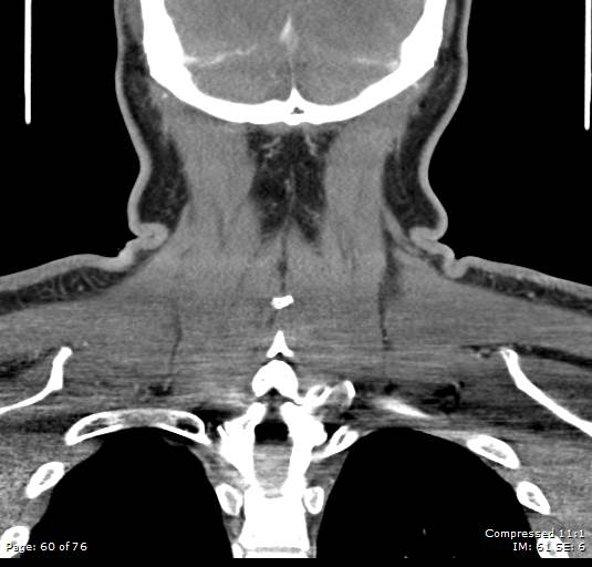 File:Acute epiglottitis (Radiopaedia 54375-60590 Coronal C+ arterial phase 60).jpg