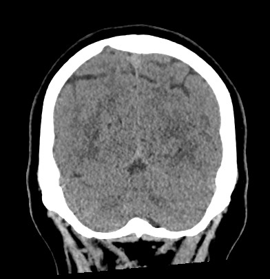 Acute internal carotid artery dissection (Radiopaedia 53541-59558 Coronal non-contrast 62).jpg