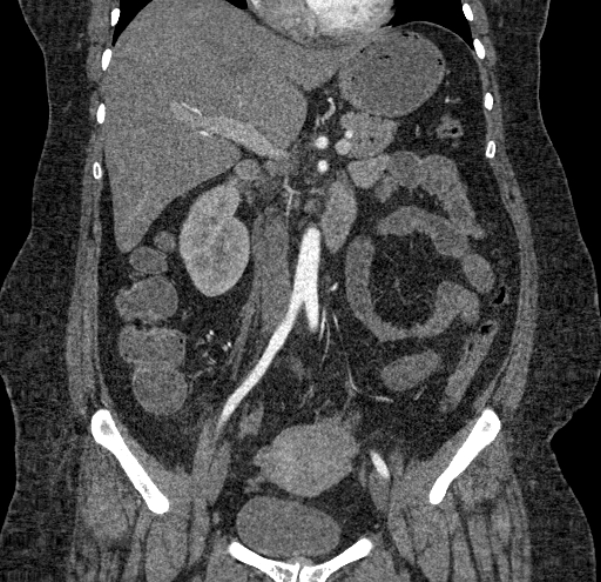 Acute mesenteric ischemia (Radiopaedia 80029-93316 Coronal C+ arterial phase 68).jpg