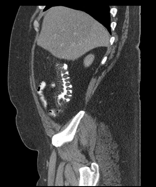 Acute mesenteric venous ischemia (Radiopaedia 46041-50383 Sagittal C+ portal venous phase 22).jpg