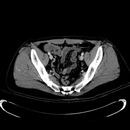 Acute myocardial infarction in CT (Radiopaedia 39947-42415 Axial C+ portal venous phase 109).jpg