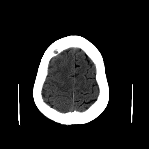File:Acute necrotizing toxoplasma encephalitis (Radiopaedia 10683-11150 B 7).jpg