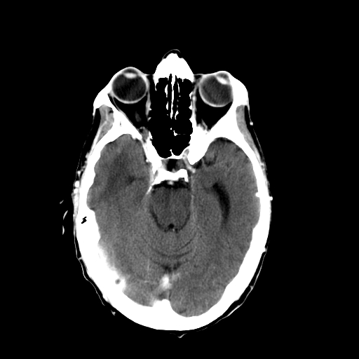 File:Acute necrotizing toxoplasma encephalitis (Radiopaedia 10683-11150 C+ arterial phase 21).jpg