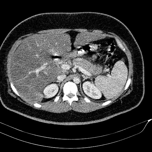 Acute on chronic pancreatitis (Radiopaedia 80902-94423 Axial C+ portal venous phase 47).jpg