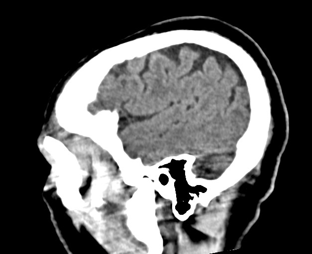 Acute on chronic subdural hematoma (Radiopaedia 78346-90966 Sagittal non-contrast 14).jpg