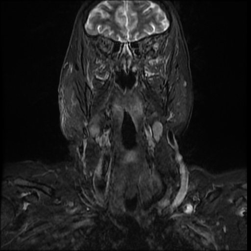 File:Acute otitis externa (Radiopaedia 57296-64236 Coronal STIR 7).jpg