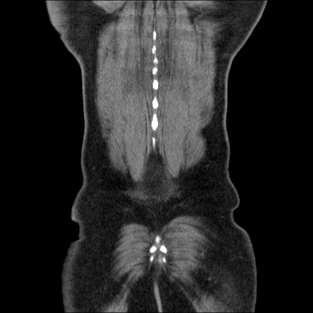Acute pancreatitis (Radiopaedia 26663-26813 Coronal C+ portal venous phase 60).jpg