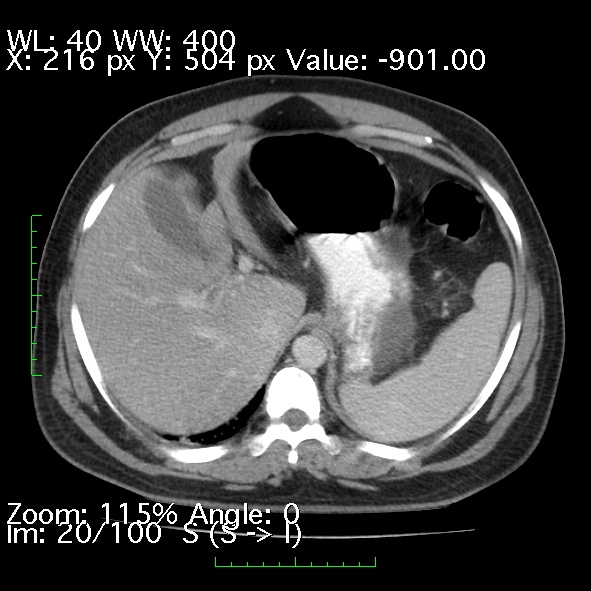 Acute pancreatitis (Radiopaedia 34043-35276 Axial C+ portal venous phase 20).jpg